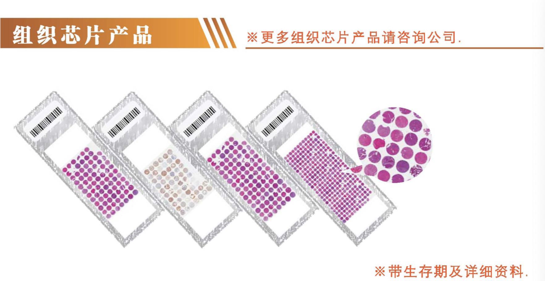 脑胶质瘤组织芯片