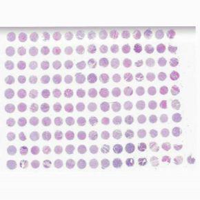 DES1501-食道鳞状细胞癌及食道组织芯片