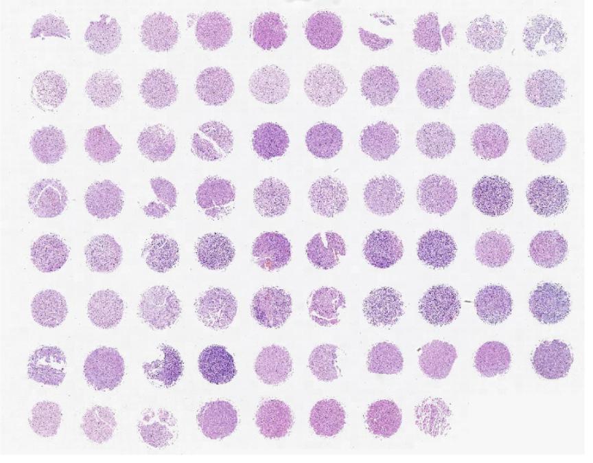 脑各级胶质瘤、近端脑及正常脑组织芯片N783701
