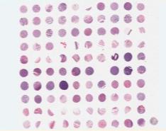 FOV1002-卵巢癌及边缘卵巢组织