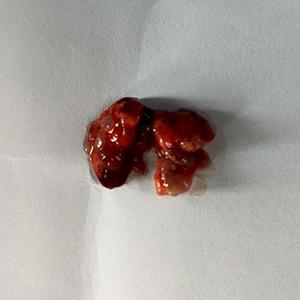 小鼠肺转移癌模型构建