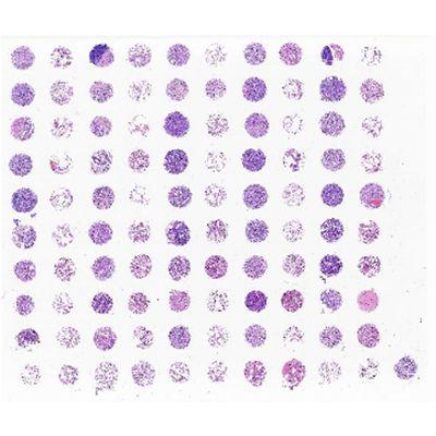 RLN10012-肺非小细胞癌及肺组织组合芯片