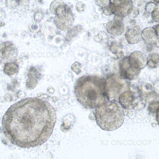 肿瘤类器官|KRAS G12D突变的非小细胞肺癌类器官模型